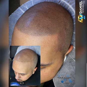 Трихопигментация