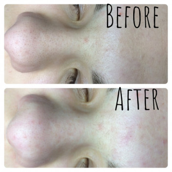 Чистка лица (механическая, ультразвуковая, комбинированная)
                    Мастер депиляции Ірина Киев