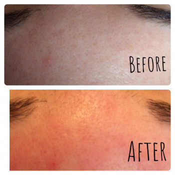 Чистка лица (механическая, ультразвуковая, комбинированная)
                    Мастер депиляции Ірина Киев