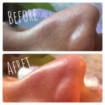 Чистка лица (механическая, ультразвуковая, комбинированная)
                    Мастер депиляции Ірина Киев