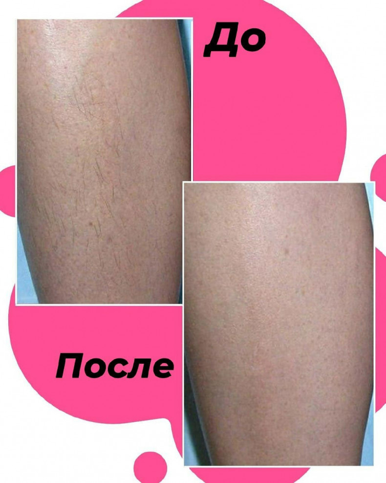 Результат 4 сеансів епіляції гомілок ❤️  #лазернаепіляція, фото - Салон красоты Мастерская Красоты "Юлии Юдиной"