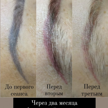 Удаление лазером. 2 процедуры.