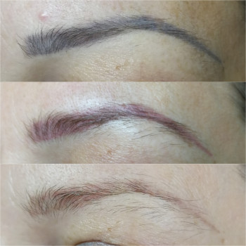 Удаление лазером 2 процедуры