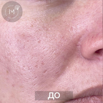 Чистка лица
                    Косметолог Ирина Одеса