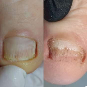 Робота з грибковим нігтем
                    Подолог Татьяна Викторовна Запорожье