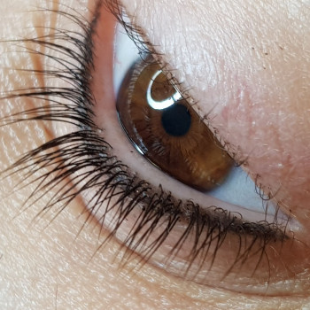 Зажившая межресничная стрелка