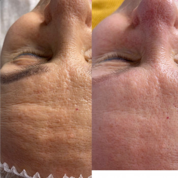 Комплексная омолаживающая процедура для лица.