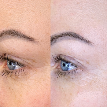 Результат после одной процедуры .