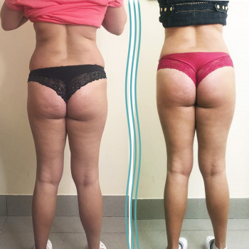 Липолитики (липолиз) против лишних сантиметров
                    Косметологический центр Body House Киев