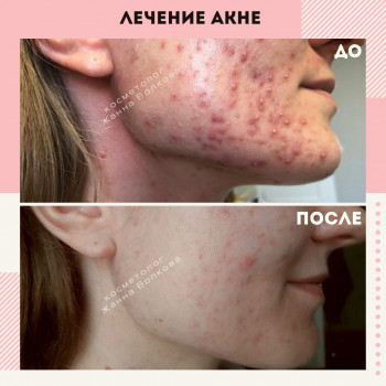Лечение Акне
                    Косметолог Жанна Київ