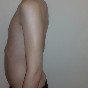 Через 3 дня реабилитации