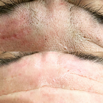 Фото з портфоліо косметолога Валентина Буданова (Дніпро)