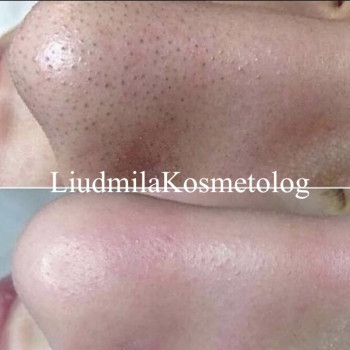 Чистка лица
                    Косметолог-инъекционист Людмила Одесса