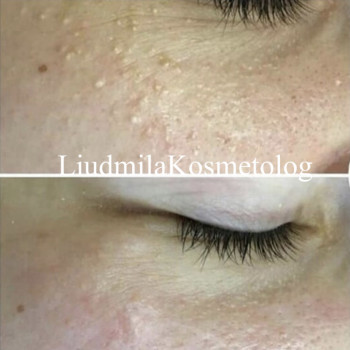 Чистка лица
                    Косметолог-инъекционист Людмила Одесса