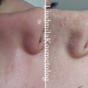 Чистка лица
                    Косметолог-инъекционист Людмила Одесса