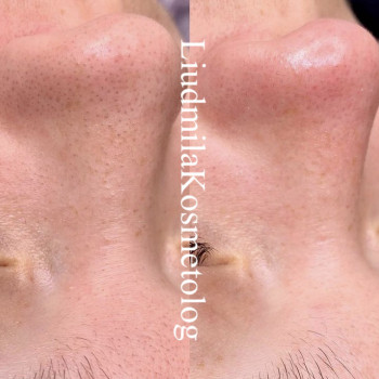 Чистка лица
                    Косметолог-инъекционист Людмила Одесса