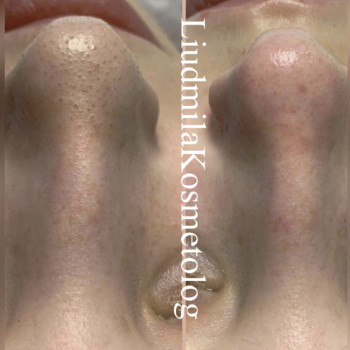 Чистка лица
                    Косметолог-инъекционист Людмила Одесса