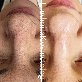 Чистка лица
                    Косметолог-инъекционист Людмила Одесса