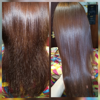 Биксипластия