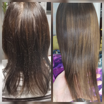 Биксипластия