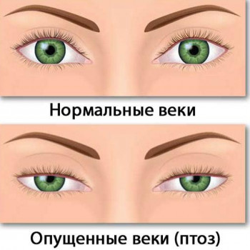 Профилактика опущения верхнего века
                    Косметолог-ін'єкціоніст Ирина Херсон