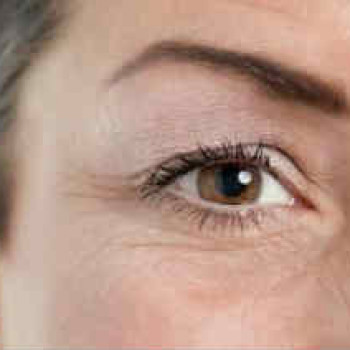 Начинается возростное написание кожи верхнего века)