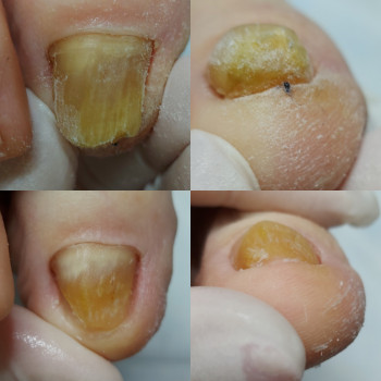 Робота з грибковим нігтем
                    Подолог Татьяна Викторовна Запорожье