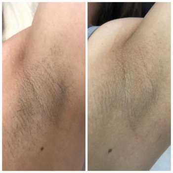 Лазерная эпиляция рук
                    Косметолог-ін'єкціоніст Наталия Одеса