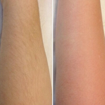 Лазерная эпиляция подмышки
                    Косметолог-инъекционист Наталия Одесса