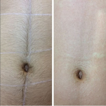 Лазерная эпиляция подмышки
                    Косметолог-инъекционист Наталия Одесса