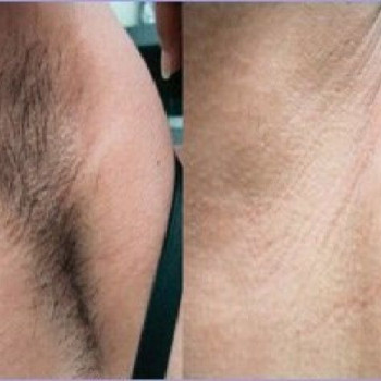 Лазерная эпиляция подмышки
                    Косметолог-инъекционист Наталия Одесса