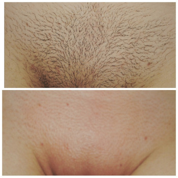 Лазерная эпиляция подмышки
                    Косметолог-инъекционист Наталия Одесса