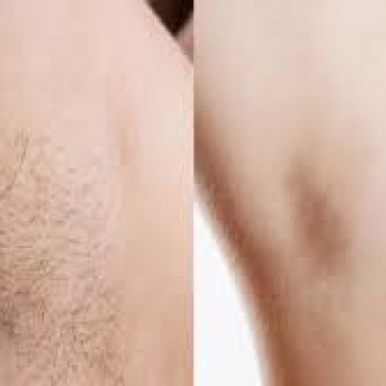 Лазерная эпиляция подмышки
                    Косметолог-инъекционист Наталия Одесса