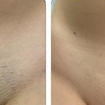 Лазерная эпиляция подмышки
                    Косметолог-инъекционист Наталия Одесса