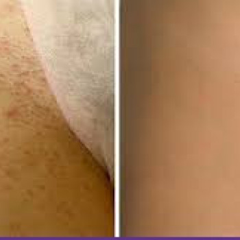 Лазерная эпиляция подмышки
                    Косметолог-инъекционист Наталия Одесса