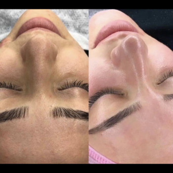 Чистка + пилинг