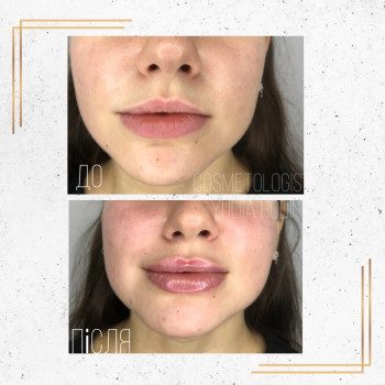 Збільшення губ та
 Вирівняння асиметрії 
Препарат Juvederm u