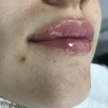 Контурна пластика губ .
Препарат Juvederm volift-1ml.


❗️❗️