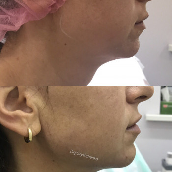 Контурна пластика нижньої третини обличчя

 