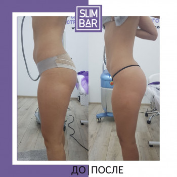 До та після 5 процедур!, фото - косметологічний центр Слім Бар