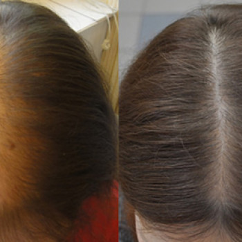 После курса из 10ти процедур!