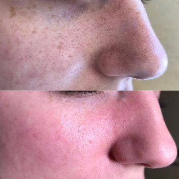 лазерне видалення пігментації у Львові