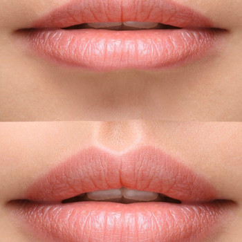 Збільшення вуст