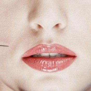 Мезотерапія