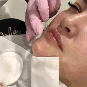 Контурна пластика