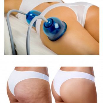 Результати вакуумно-роликового масажу