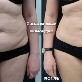 Липосакция живота + лобковая зона.