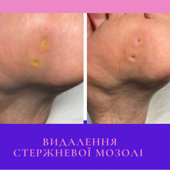 Видалення стержневої мозолі
                    Подолог Лілія Черкассы