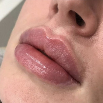 Збільшення губ