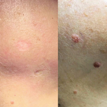 Видалення новоутворень